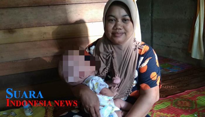 Bayi Penderita Hidrosefalus di Abdya, Butuh Uluran Tangan Dermawan 